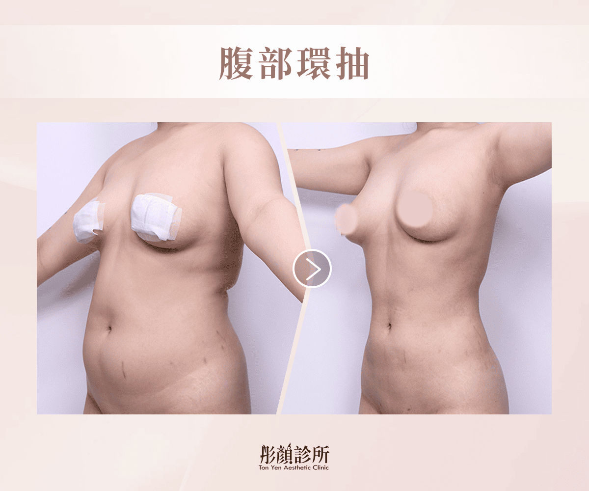 腹部環抽案例術前術後對比照